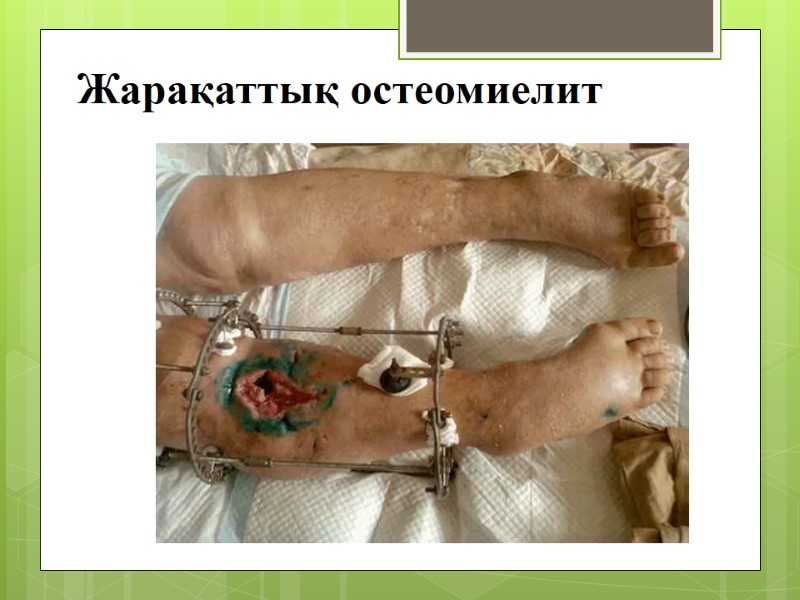 Жарақаттық остеомиелит